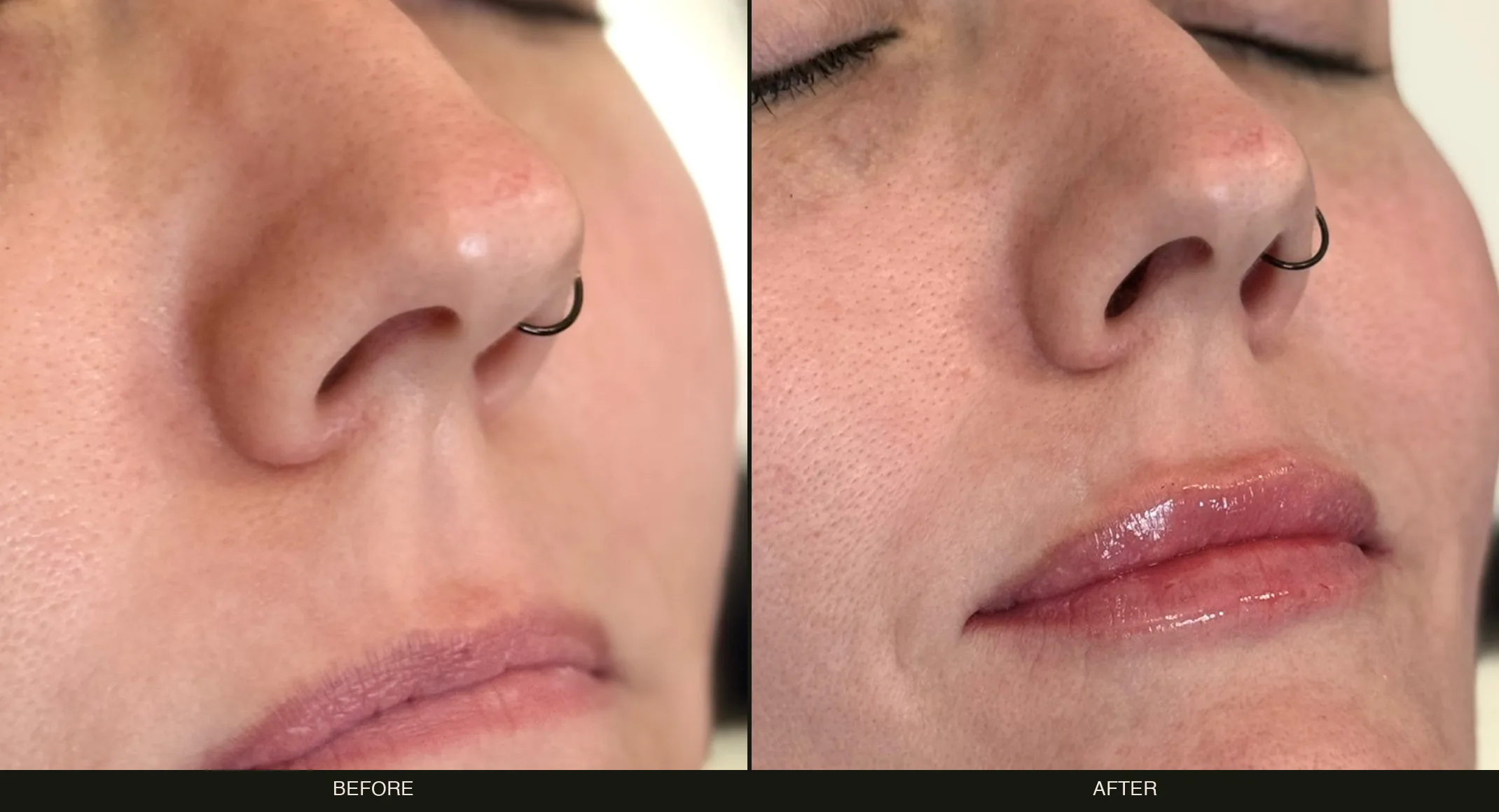 Before and after natural lip filler on an actual Olympia Aesthetics patient in Palm Harbor