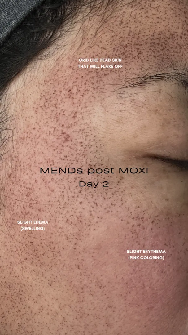 MENDs, the tiny dark specks on the skin two days after a MOXI laser treatment, on an actual Olympia Aesthetics patient