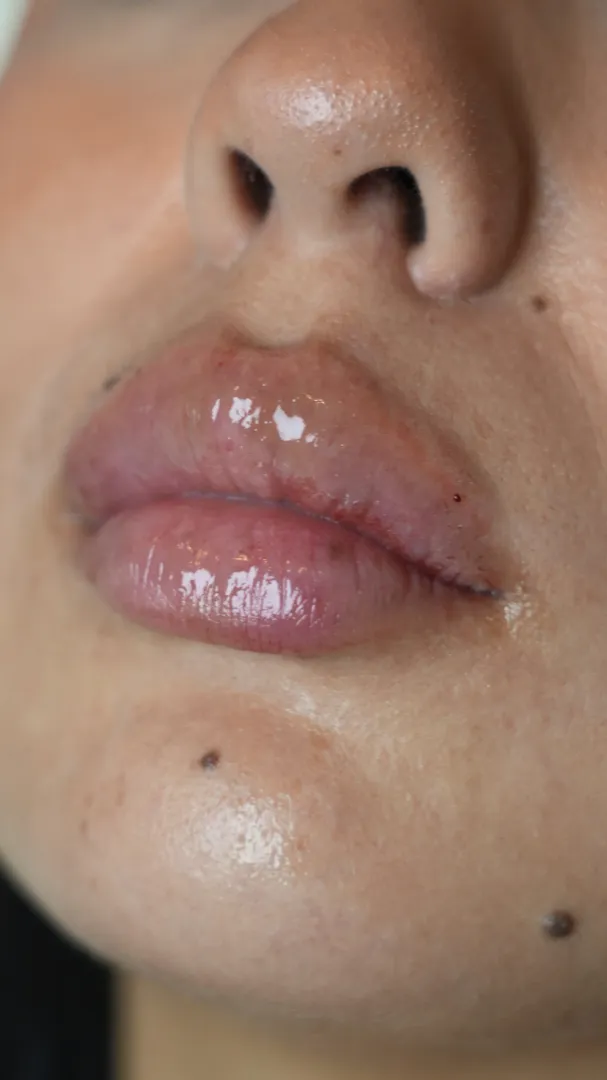 Close-up of soft, natural lip filler results on an Olympia Aesthetics patient