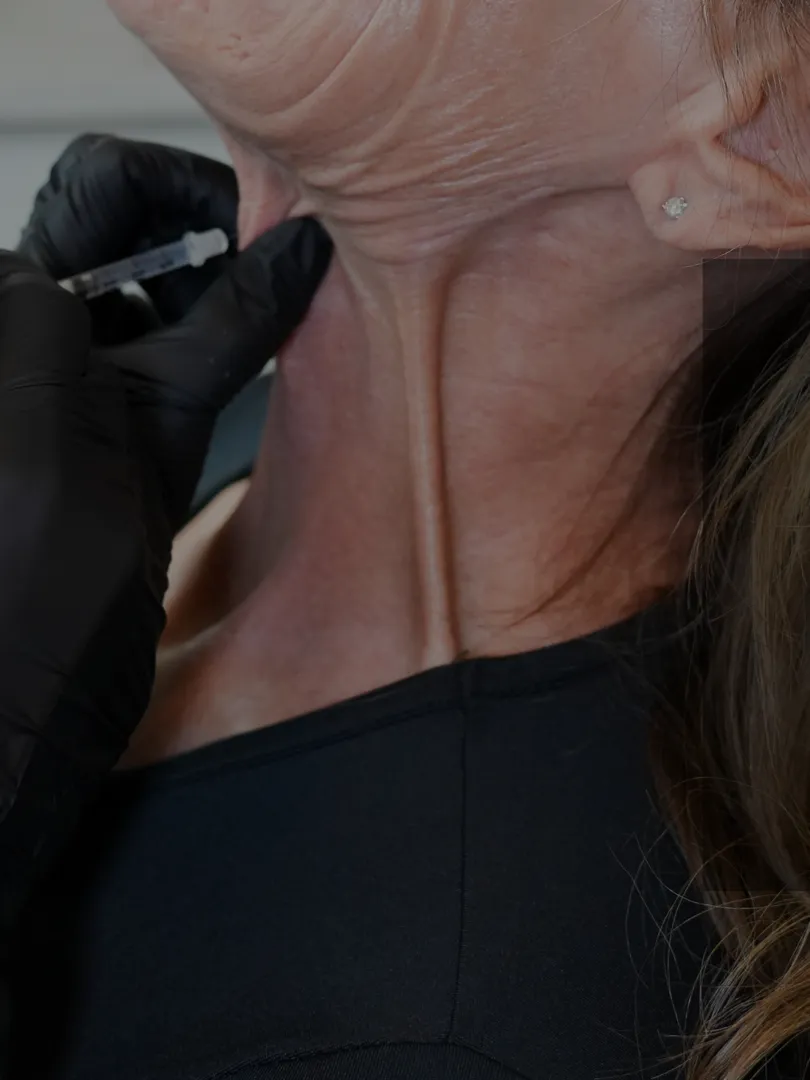 Platysmal band neck Botox treatment at Olympia Aesthetics in Palm Harbor