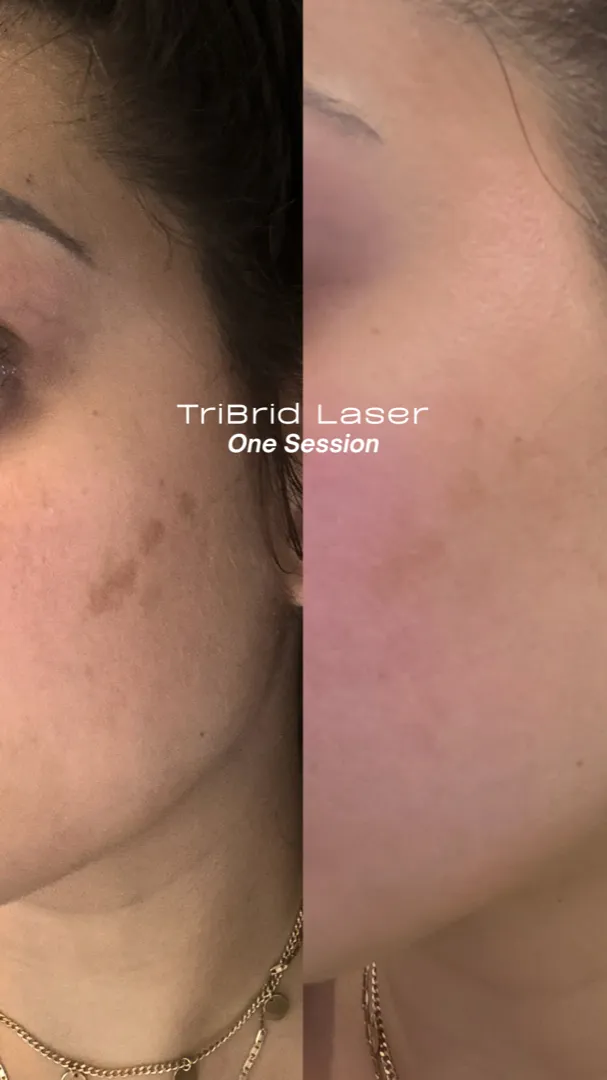 Split-face before and after of melasma clearance after one HALO TRIBRID session on an actual Olympia Aesthetics patient