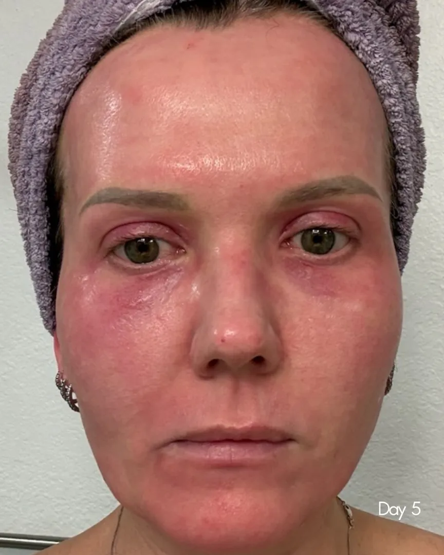 Skin five days after Sciton Contour TRL resurfacing as peeling resolves