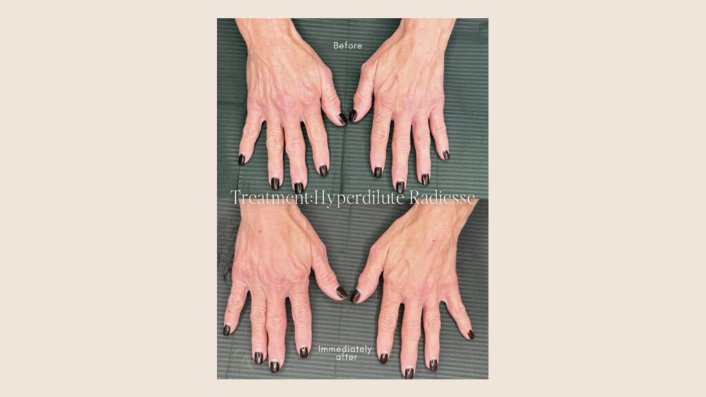 Hyperdilute Radiesse hand rejuvenation before and immediately after, actual patient treated by Olympia Morris PA-C in Palm Harbor FL