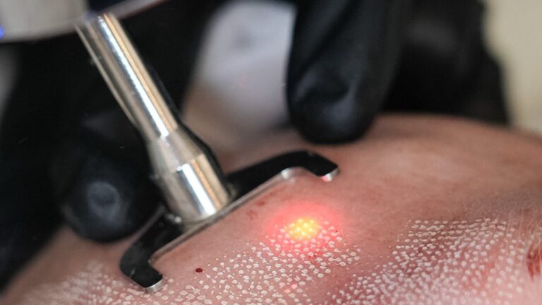 Acne Scars and Large Pores: What Actually Works