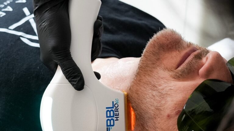 BBL BroadBand Light: How It Treats Sun Damage and Redness